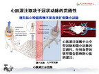 心绞痛治疗的全新理念--全冠脉扩张与缺血预适应